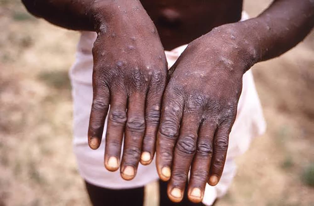 Bissau confirms first mpox case
