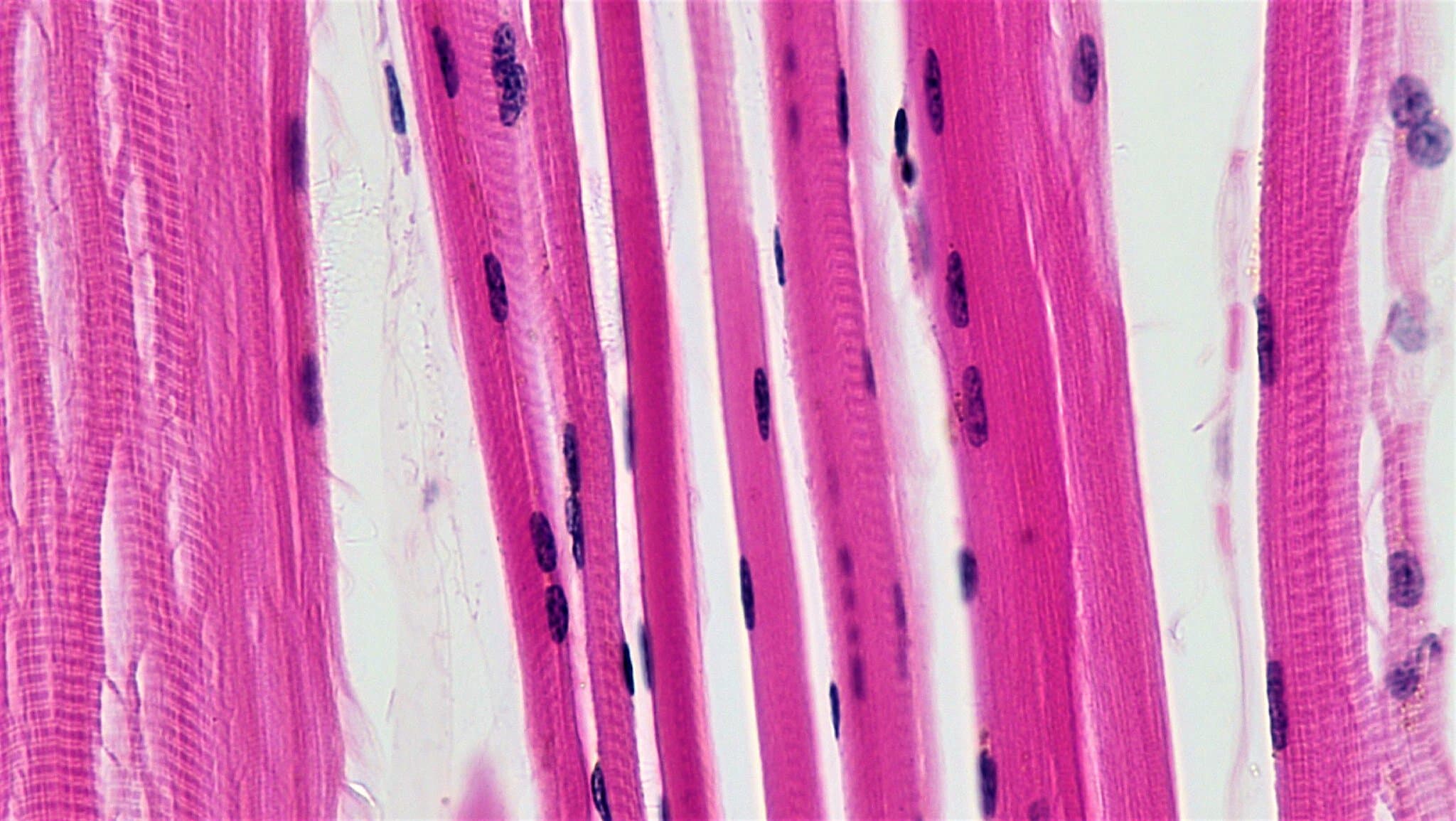 Dialing back stiffness may protect muscles in myotonic dystrophy
