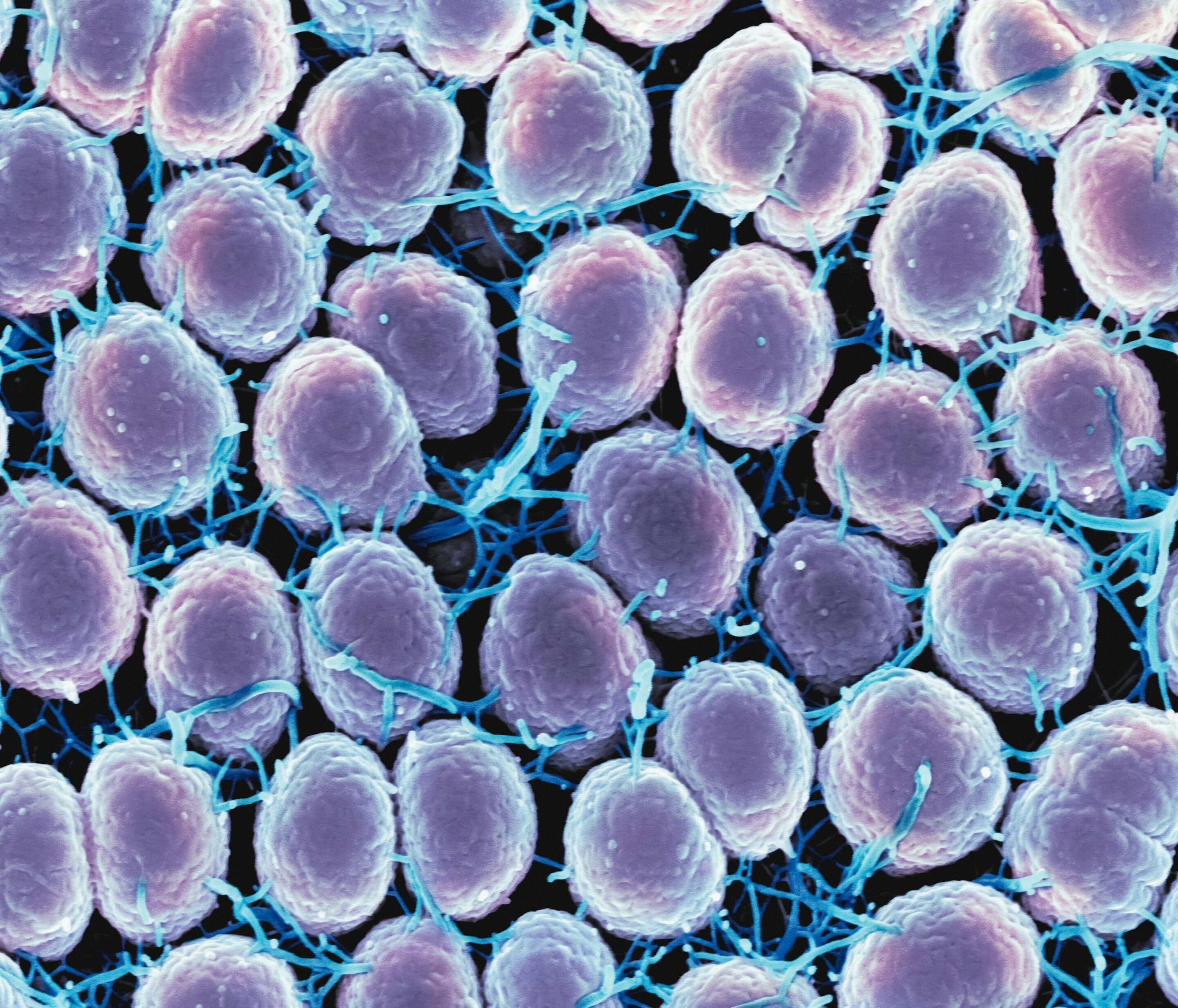 Meningococcal B vaccine ineffective in gonorrhea prevention for men who have sex with men
