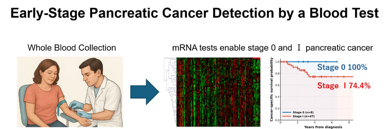 Blood gene test detects 90% of early-stage pancreatic cancers