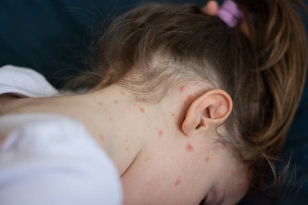 NICD sees increase in measles cases, Western Cape ranked 2nd nationally