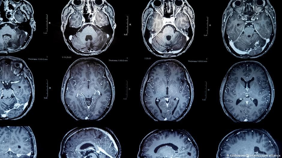 Brain tumors: New vaccine offers patients hope for more time