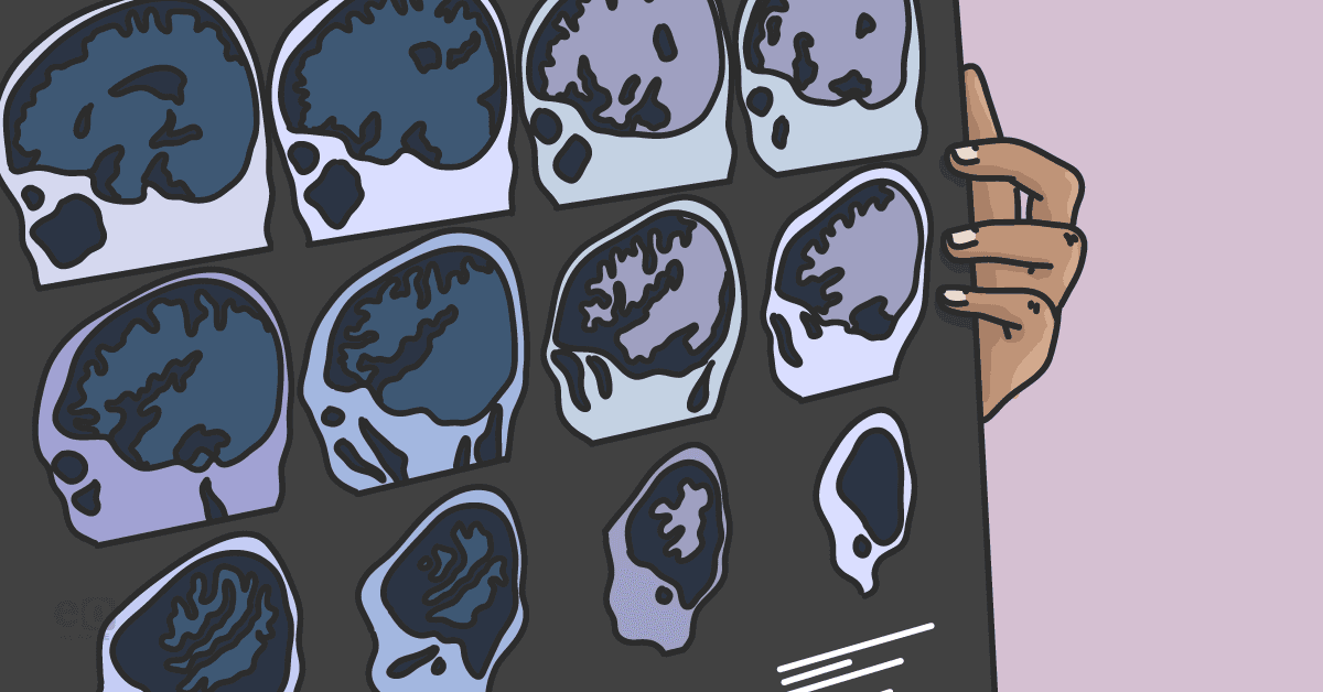 Study identifies stroke risks following ischemic ocular events