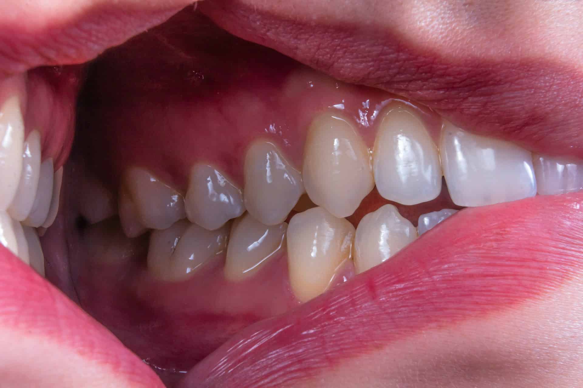 A Five-Day Fasting Diet Could Help Ease Gum Disease Inflammation