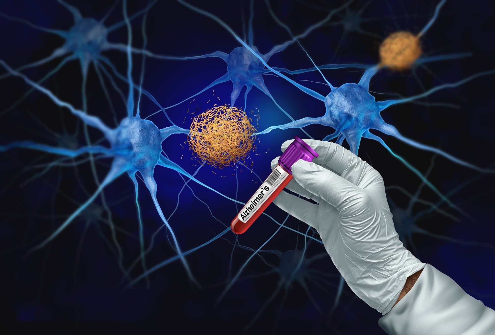 Blood p-tau217 levels signal cognitive impairment risk years before symptoms emerge